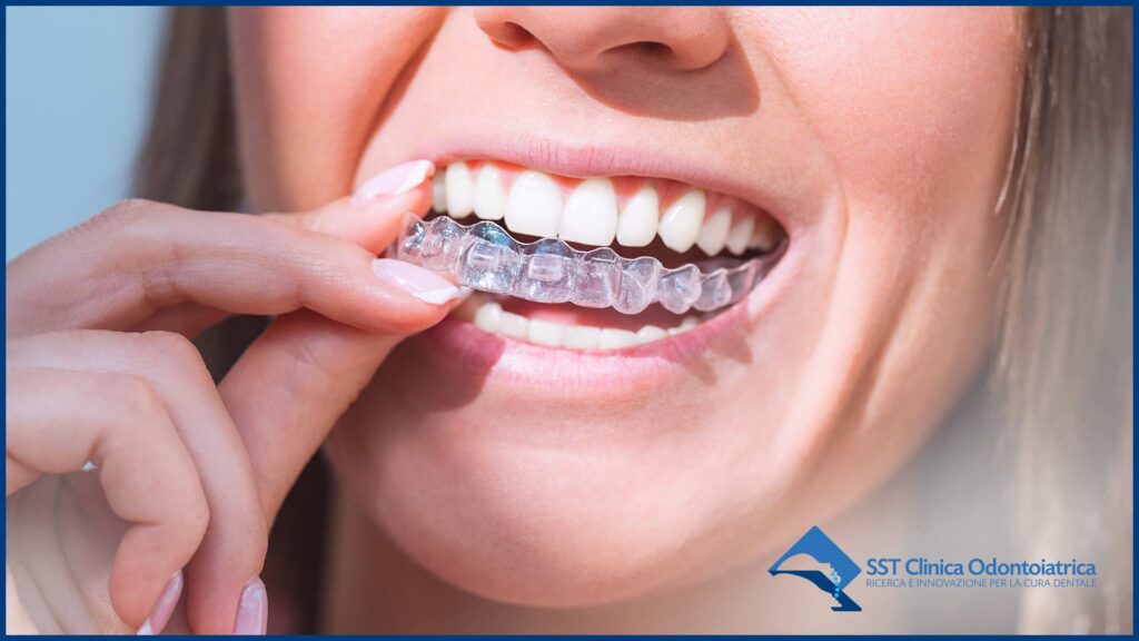 allineatori dentali